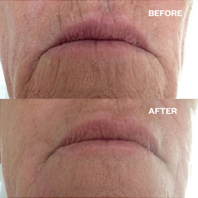 Wrinkles Schminkles Mouth & Lip Wrinkle Patches - 2 Patches Face Masks   